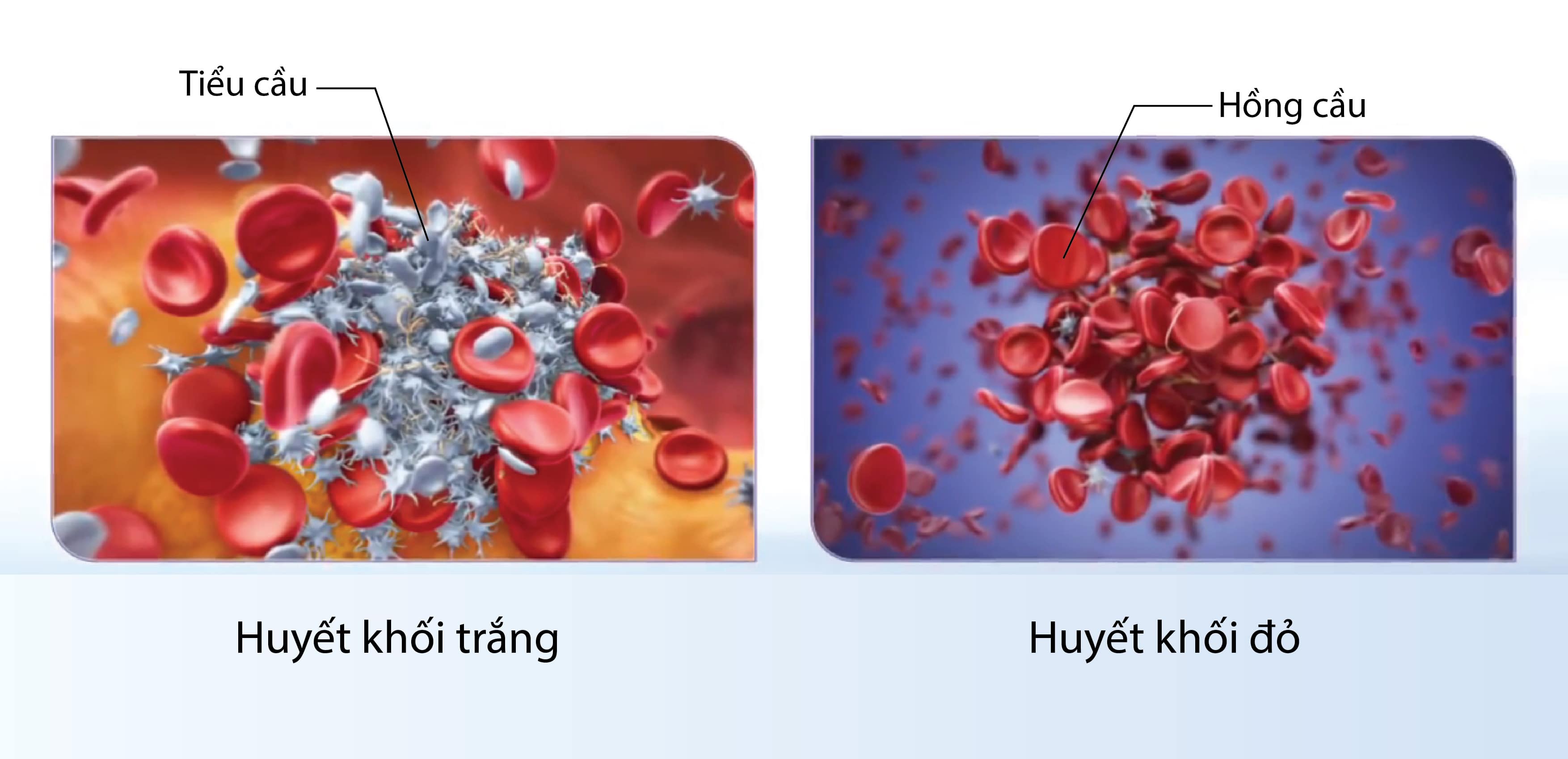 Huyết khối (Cục máu đông) - Hình ảnh minh họa